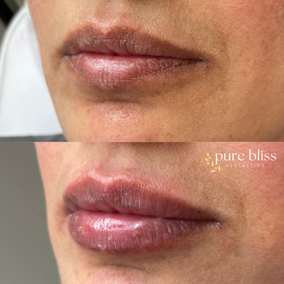 Lip filler before and after with 0.5ml of Restylane Kysse 