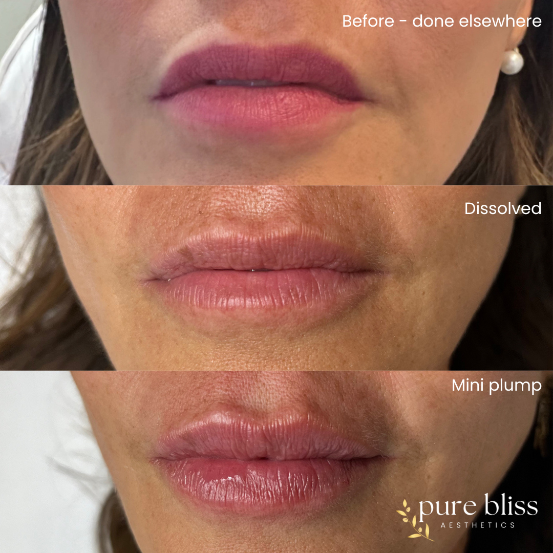 Lip filler before and after. Before dissolving, after dissolving, and after 0.5ml of Restylane Kysse.