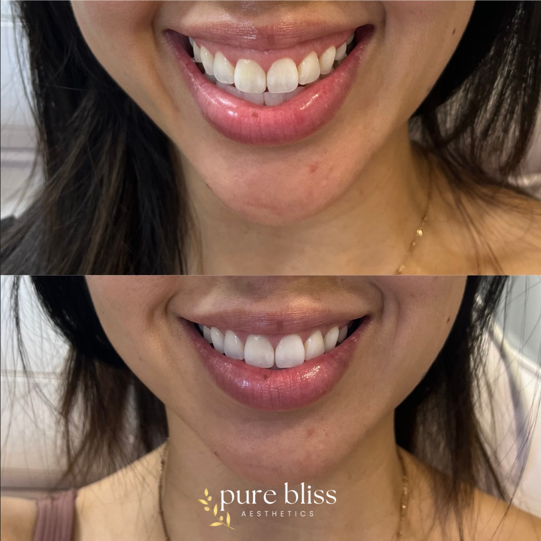 Before and after of a woman who had botox injections for her gummy smile.