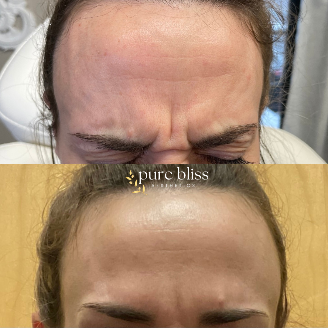 Close-up of forehead wrinkles before and after Botox treatment. Top shows deep frown lines, bottom shows smoothed skin after Botox.