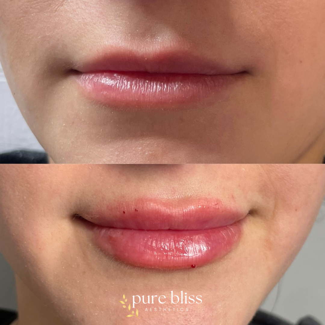 Lip filler before and after with 1ml of Restylane Kysse 