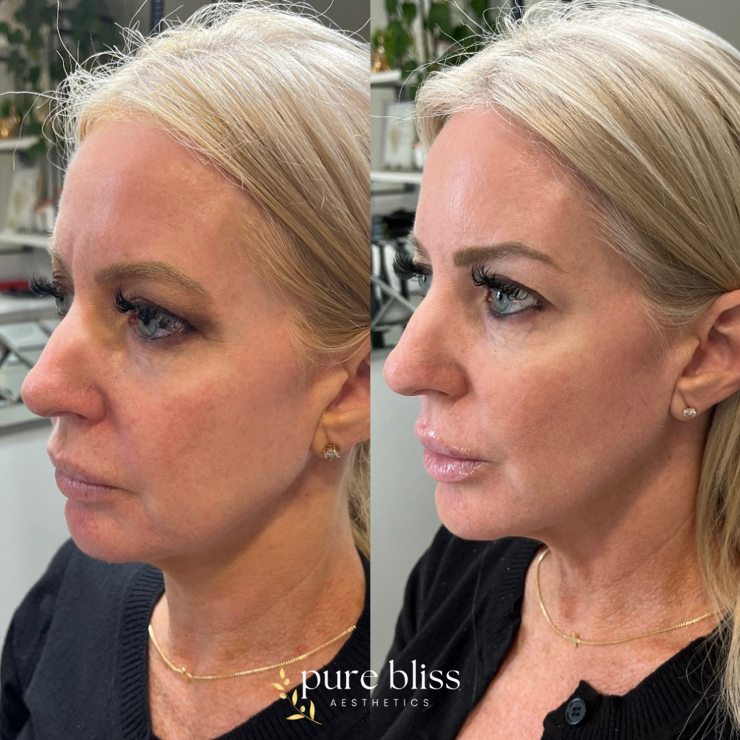 8 point lift before and after using dermal filler. Here we strategically placed 2ml of filler in the cheeks, chin, jawline, and nasolabial folds.