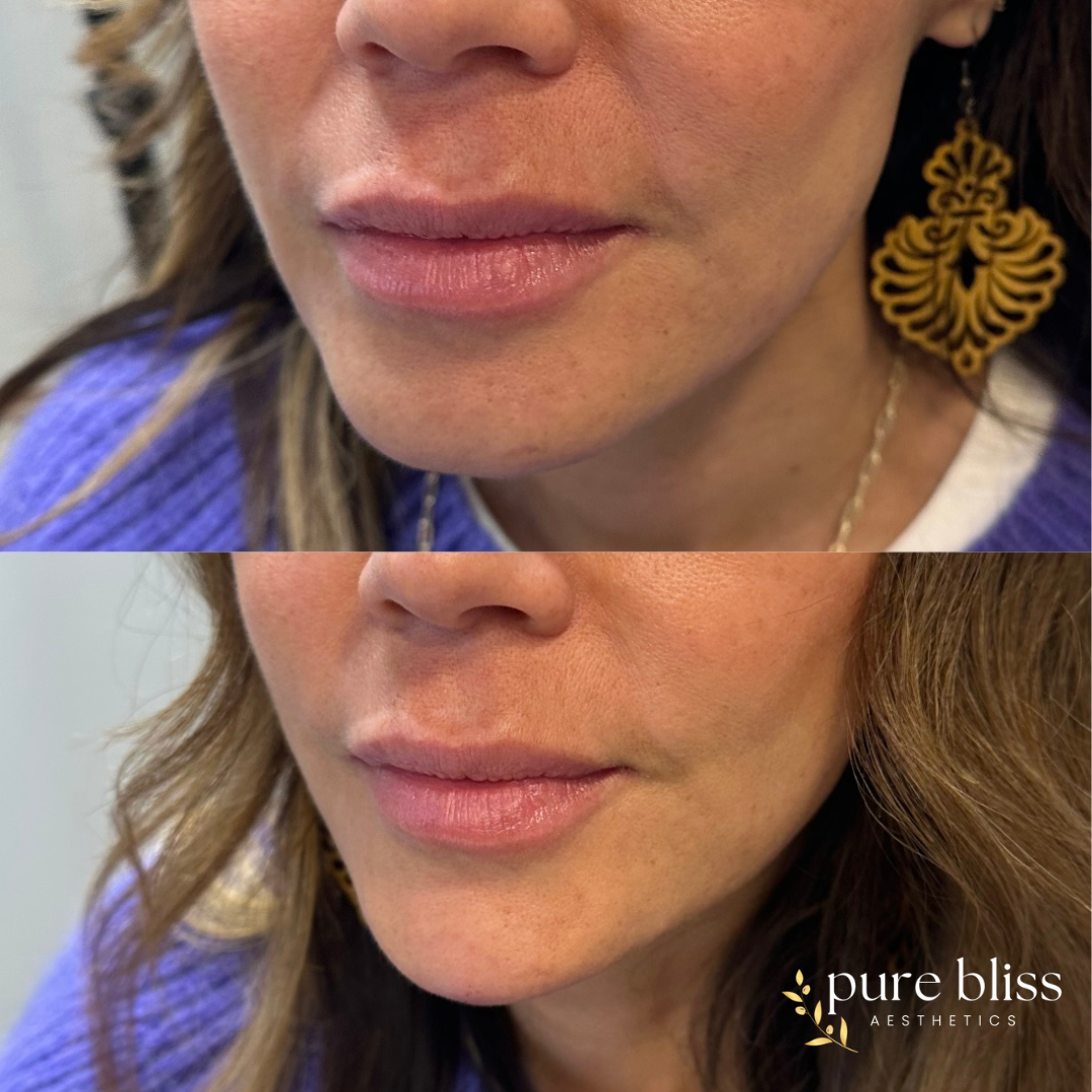 Filler before and after using 1ml of Restylane Defyne in the chin.