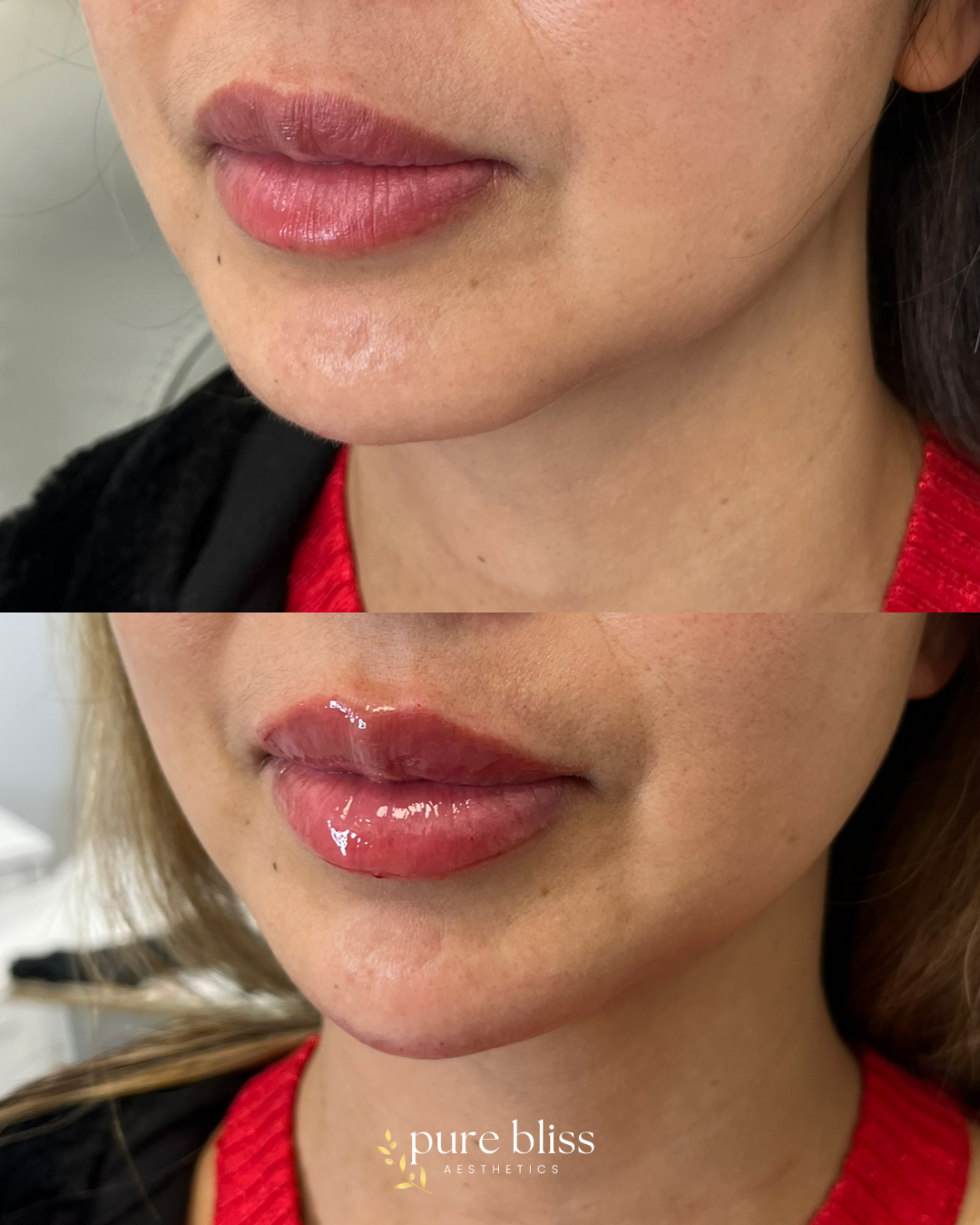Filler before and after with 1.2ml Revanesse Versa in the lips and chin