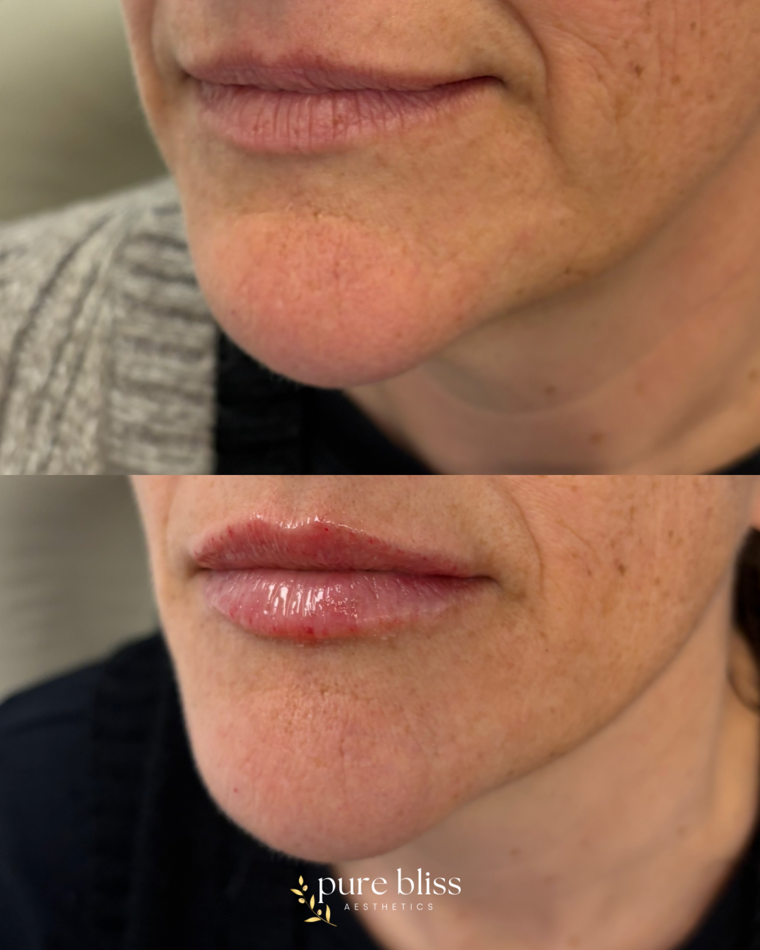Half syringe of lip filler using 0.6ml Revanesse Versa.