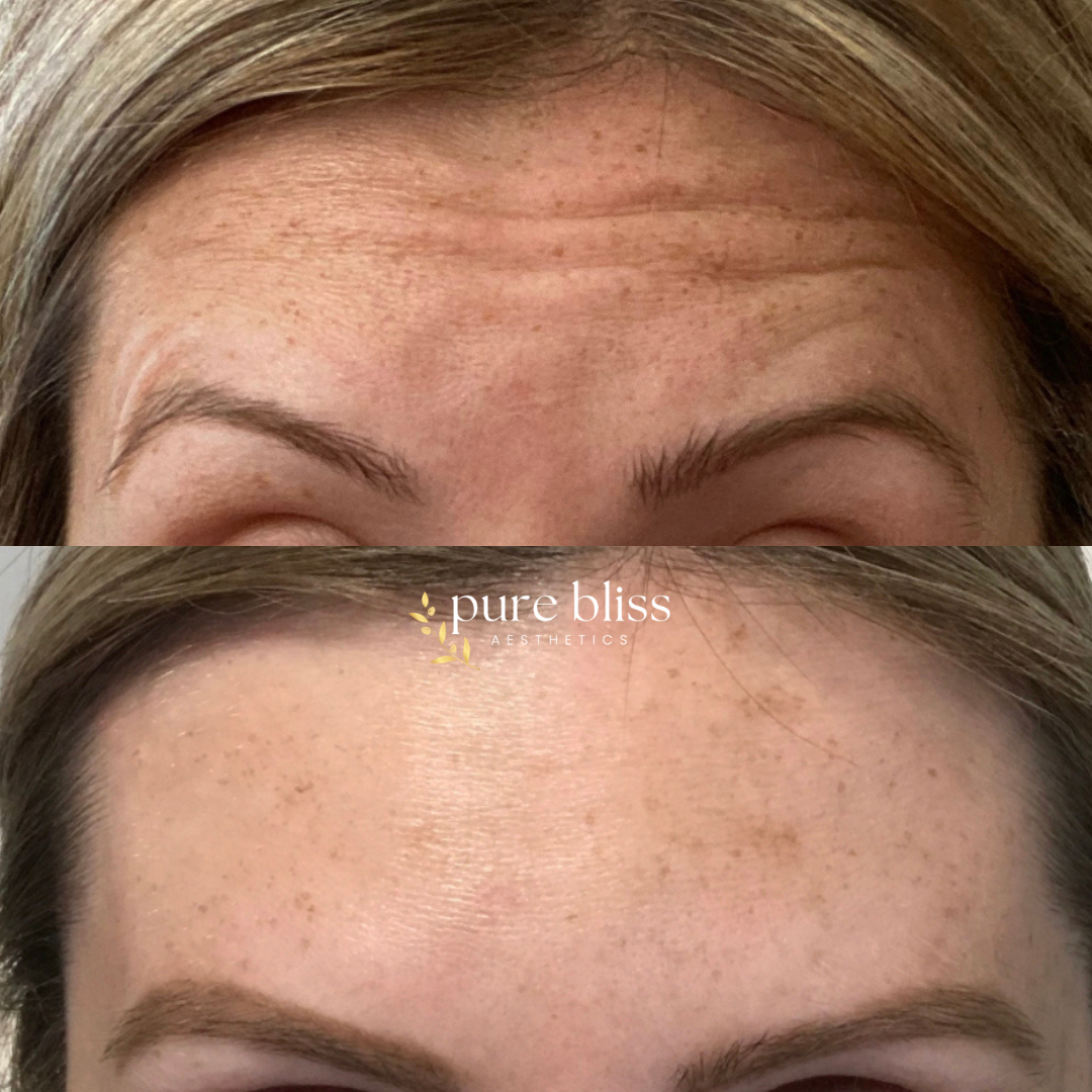 Before and after images of a woman's forehead showing the results of Botox treatment. The top image shows the forehead with prominent wrinkles, while the bottom image shows a smooth, wrinkle-free forehead.