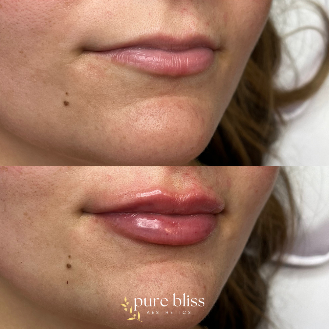 Lip filler before and after with 1ml of Revanesse Versa