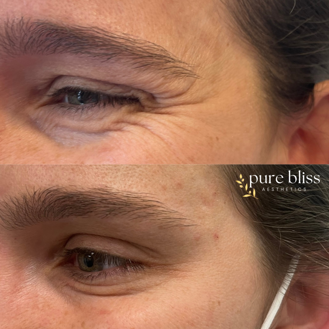 Close-up comparison of a woman's eyes showing fewer wrinkles around the eye area in the bottom image compared to the top image.
