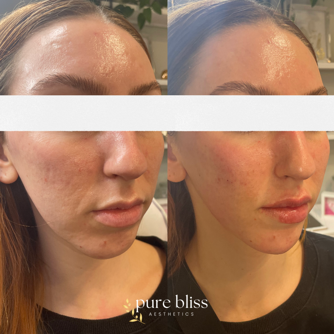 Filler before and after with 0.5ml of Restylane Kysse in the lips and 1ml of Restylane Defyne split up in the cheeks and chin.