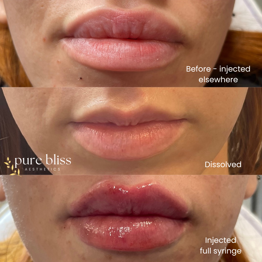 Lip filler before and after. Before dissolving, after dissolving, and after 1ml of Restylane Kysse.