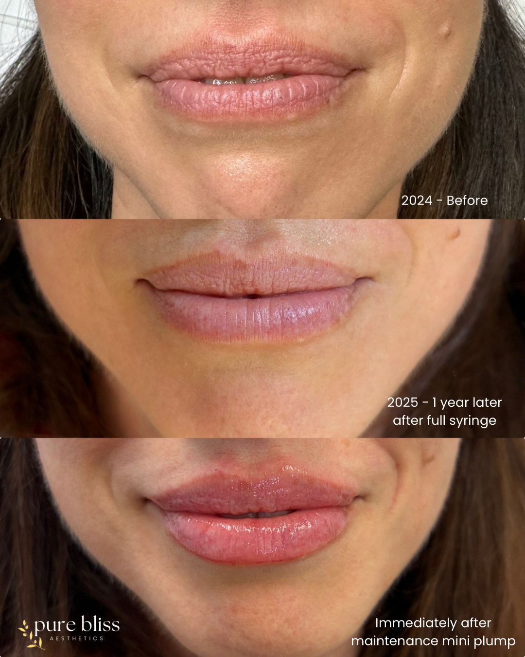 Lip building using Revanesse versa to soften and hydrate the lips.
