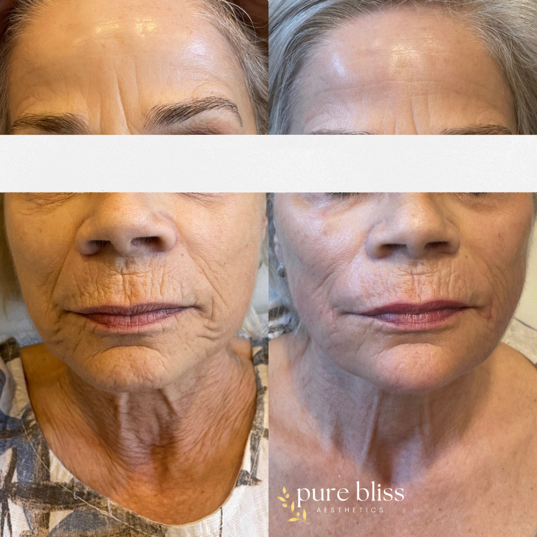 Filler before and after using Radiesse & hyperdilute Radiesse in the cheeks, chin, jawline, and peri-oral.