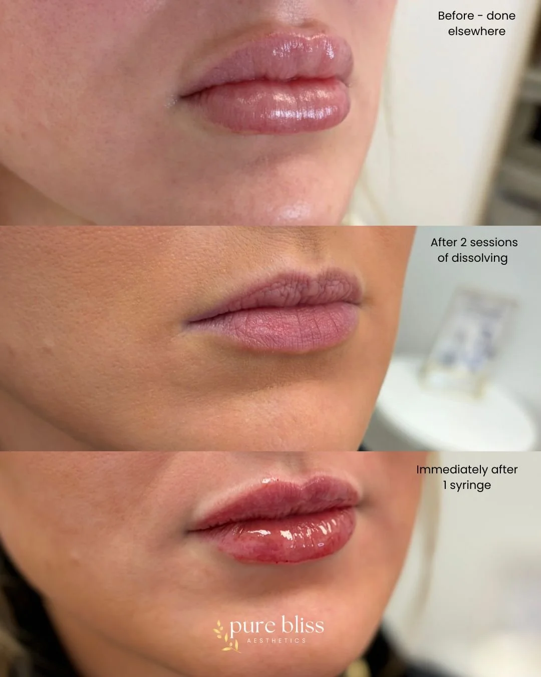 Lip filler before and after. Before dissolving, after dissolving, and after 0.8ml Versa.