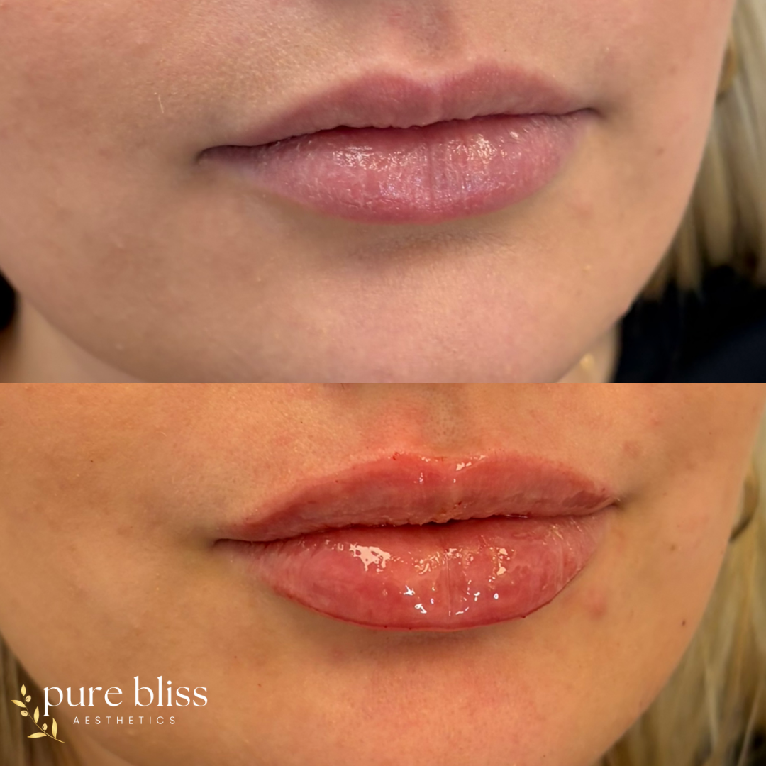 Half syringe of lip filler using 1.2ml Revanesse Versa.