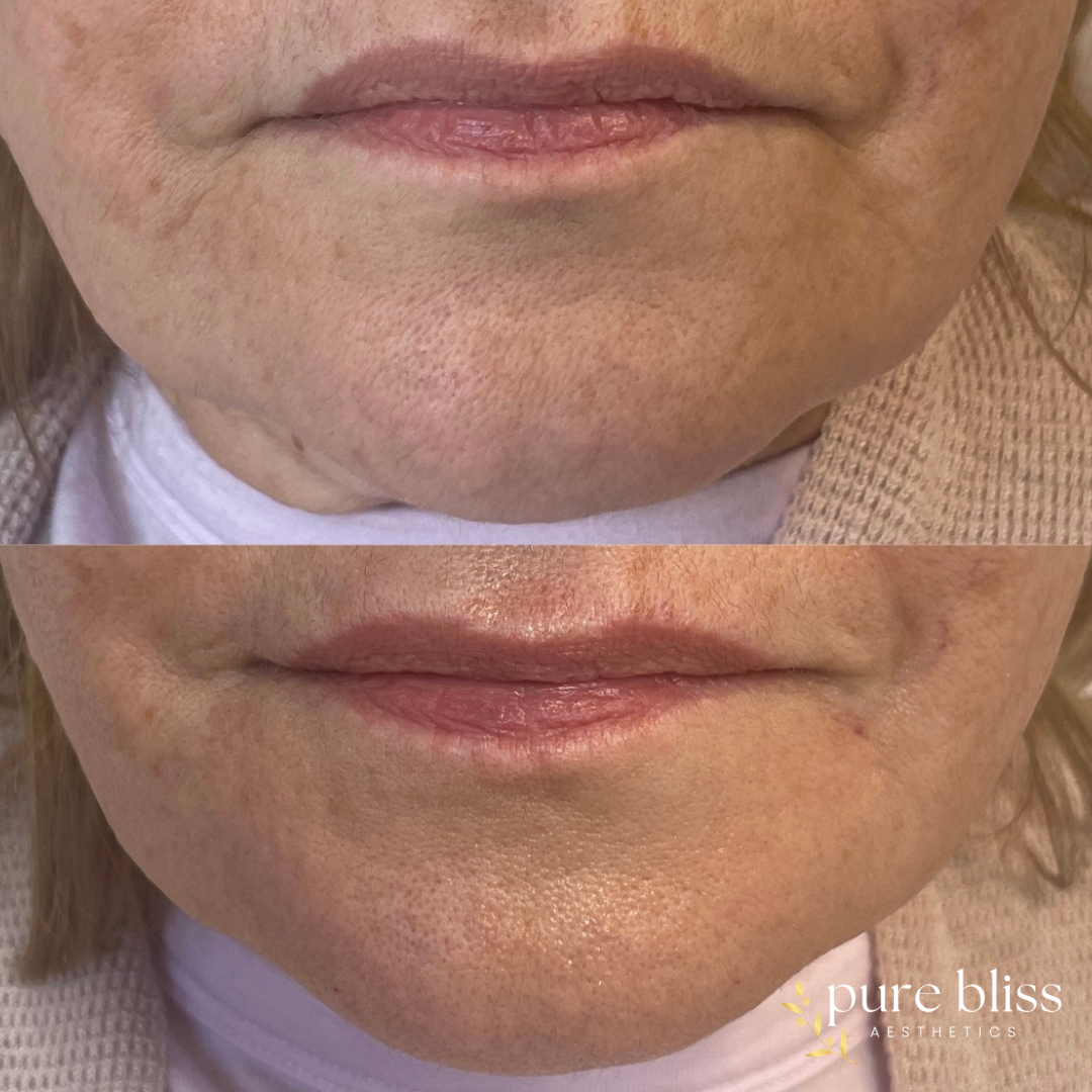 Filler before and after using 1.2ml of Revanesse Versa in the marionette lines, improving jowls.