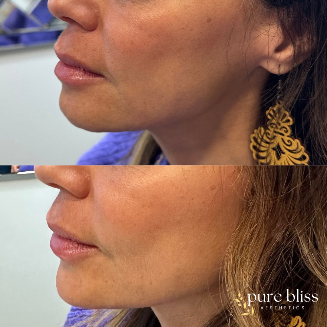 Filler before and after using 1ml of Restylane Defyne in the chin.