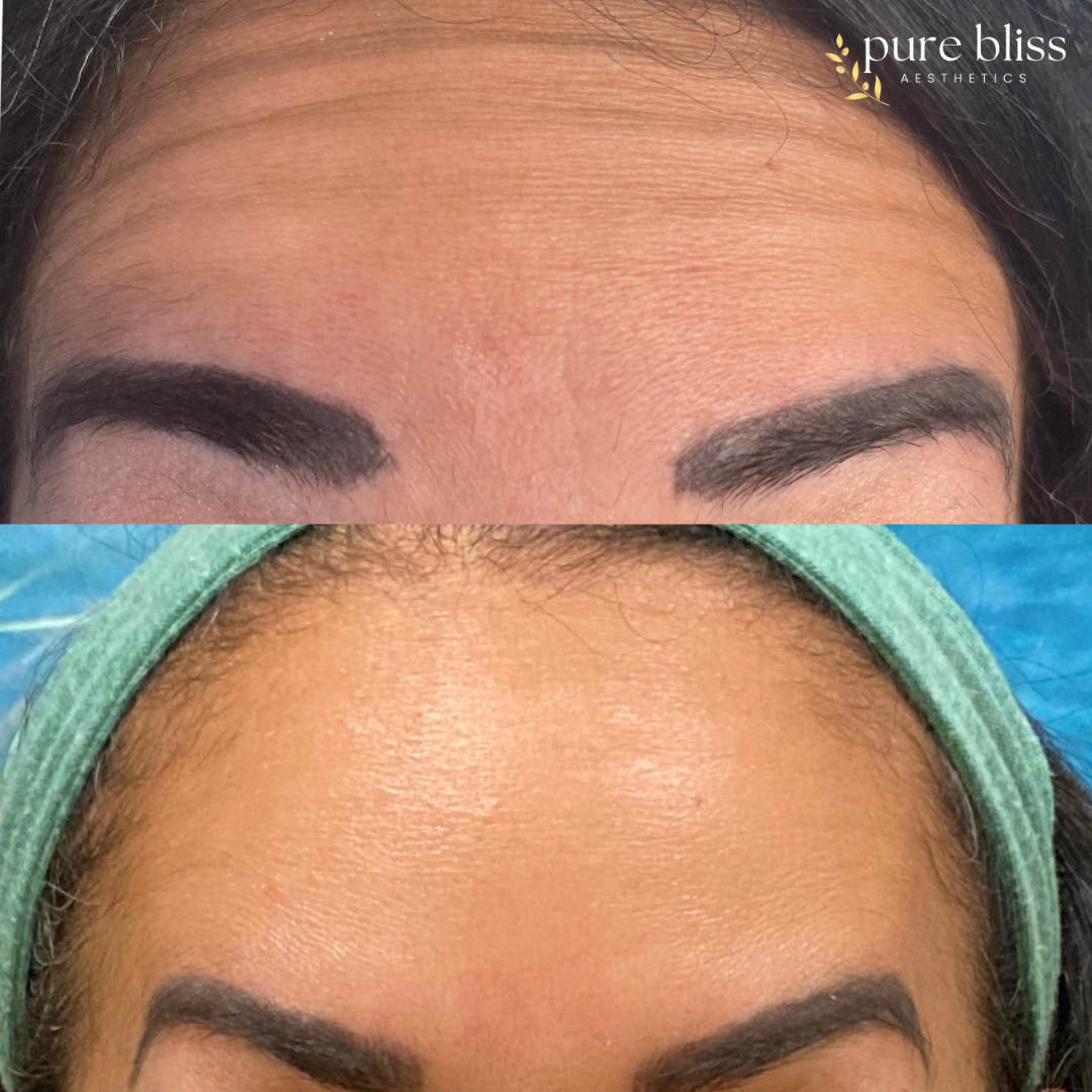 Before and after images of forehead and eyebrow enhancement, showing smoother skin and more defined eyebrows after receiving Dysport.