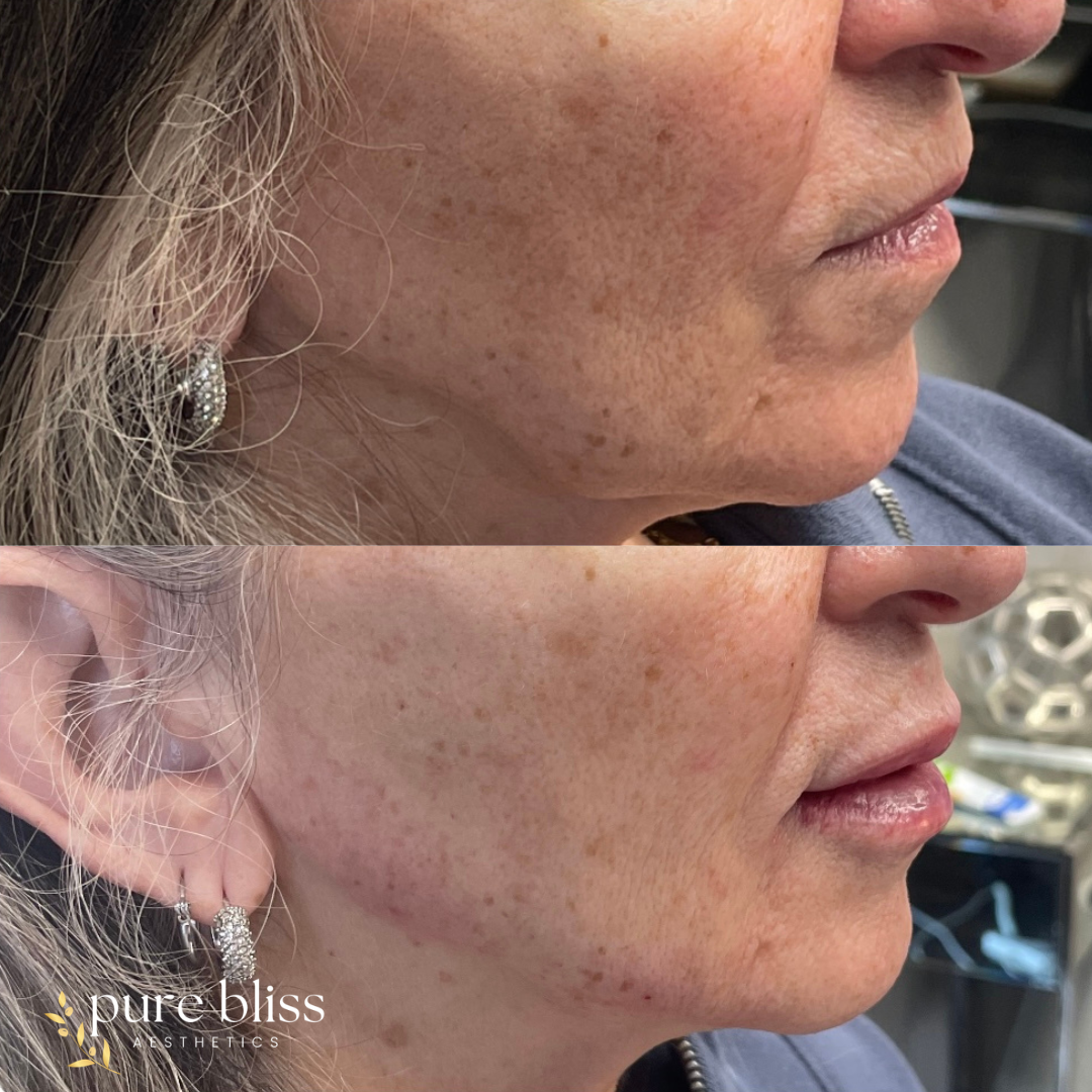 Filler before and after with 1ml of Restylane Kysse in the lips and 1ml of Restylane Defyne in the jawline.