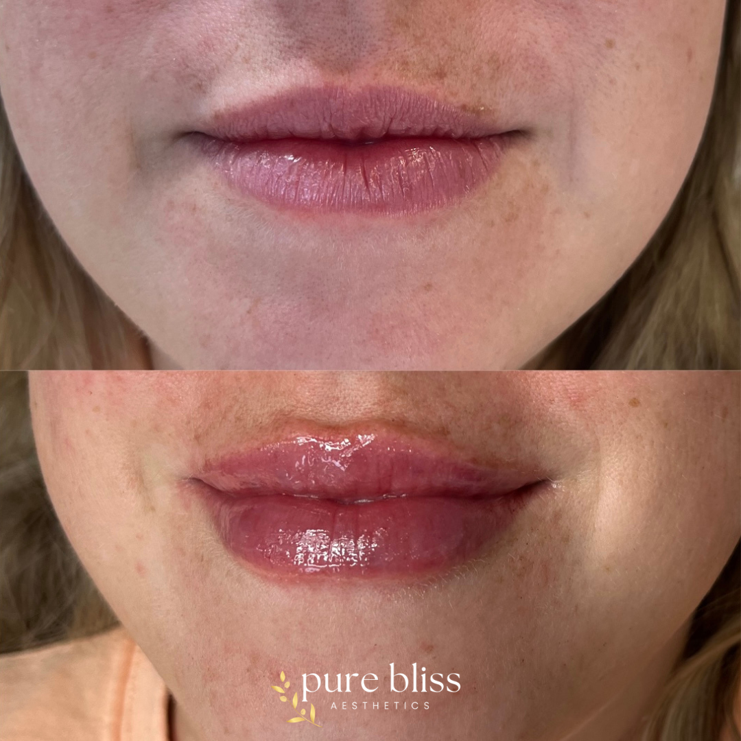 Lip filler before and after with 1ml of Restylane Kysse 