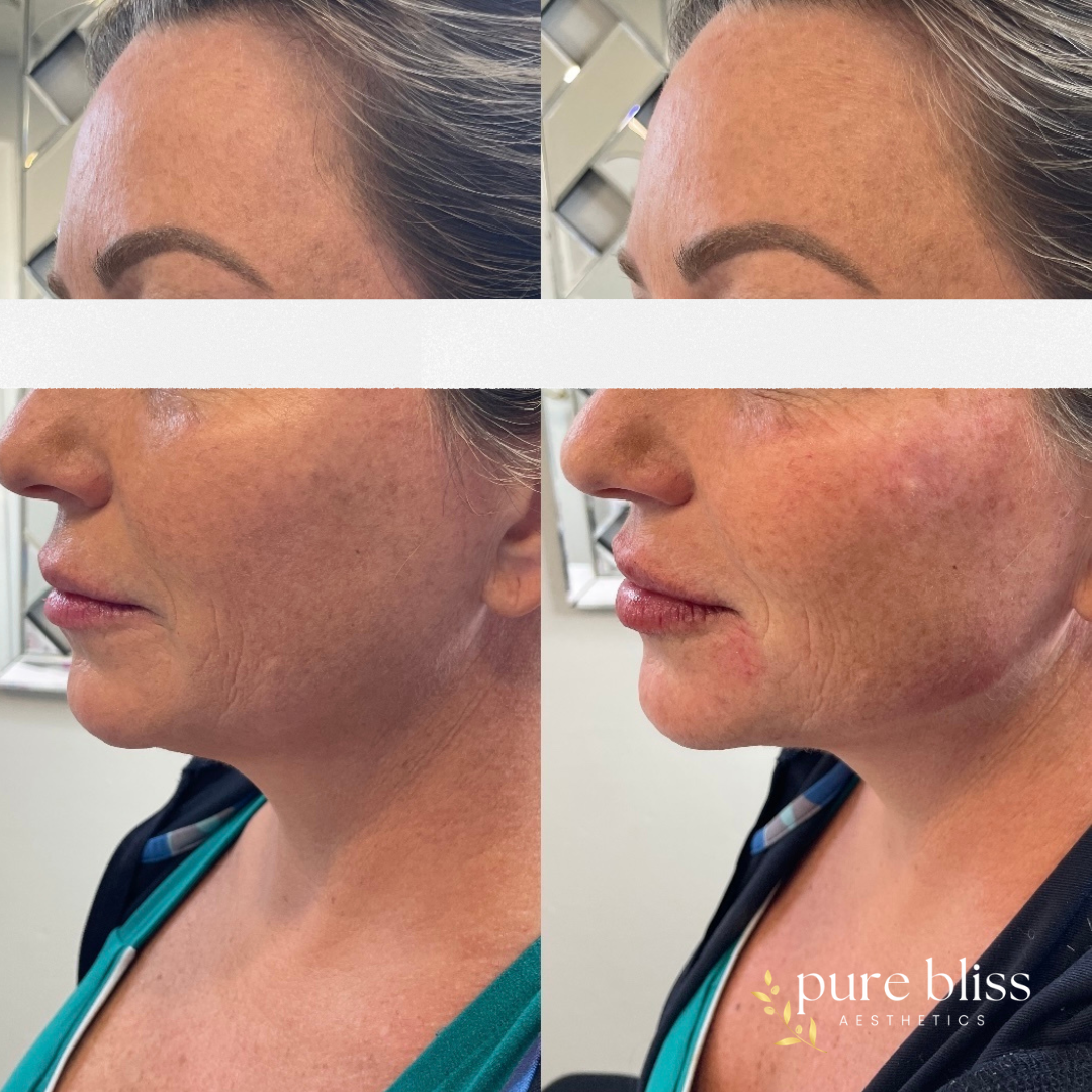 Filler before and after with 0.5ml of Restylane Kysse in the lips and 1.2ml of Revanesse Versa in the jawline, chin, and peri-oral.