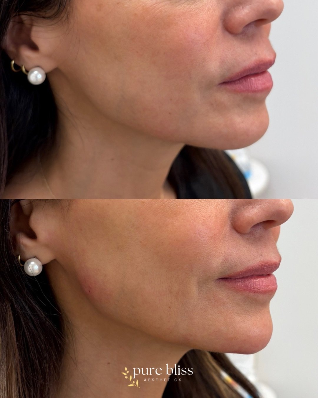 Filler before and after using 2ml of Restylane Defyne in the chin and jaw.