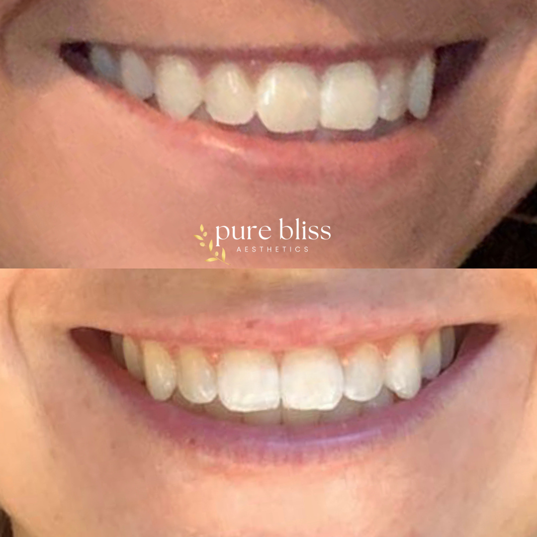 Comparison of a person's smile before and after a lip flip, showing a fuller top lip.
