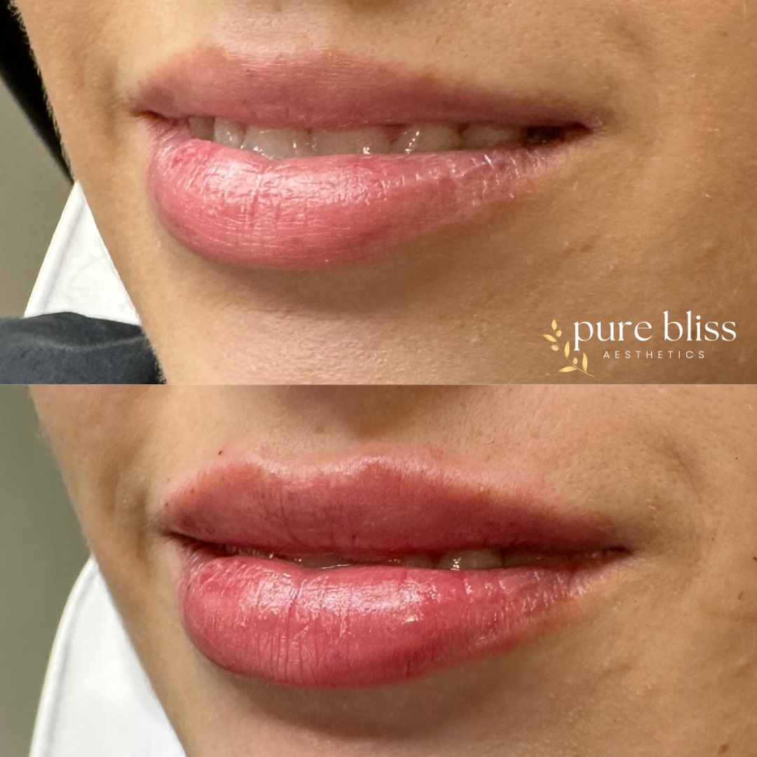 Lip filler before and after with 1ml of Restylane Kysse 