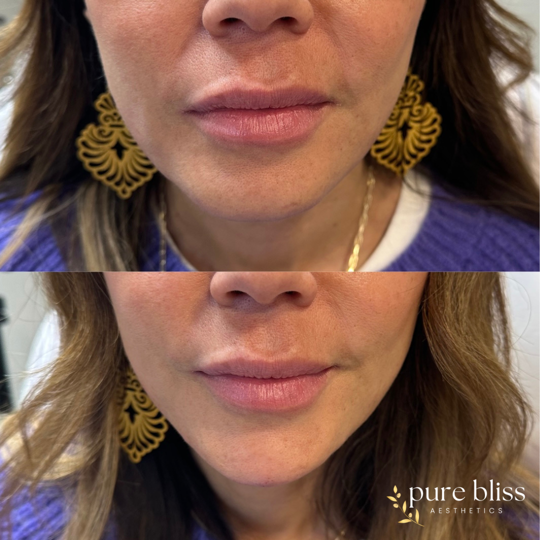 Filler before and after using 1ml of Restylane Defyne in the chin.