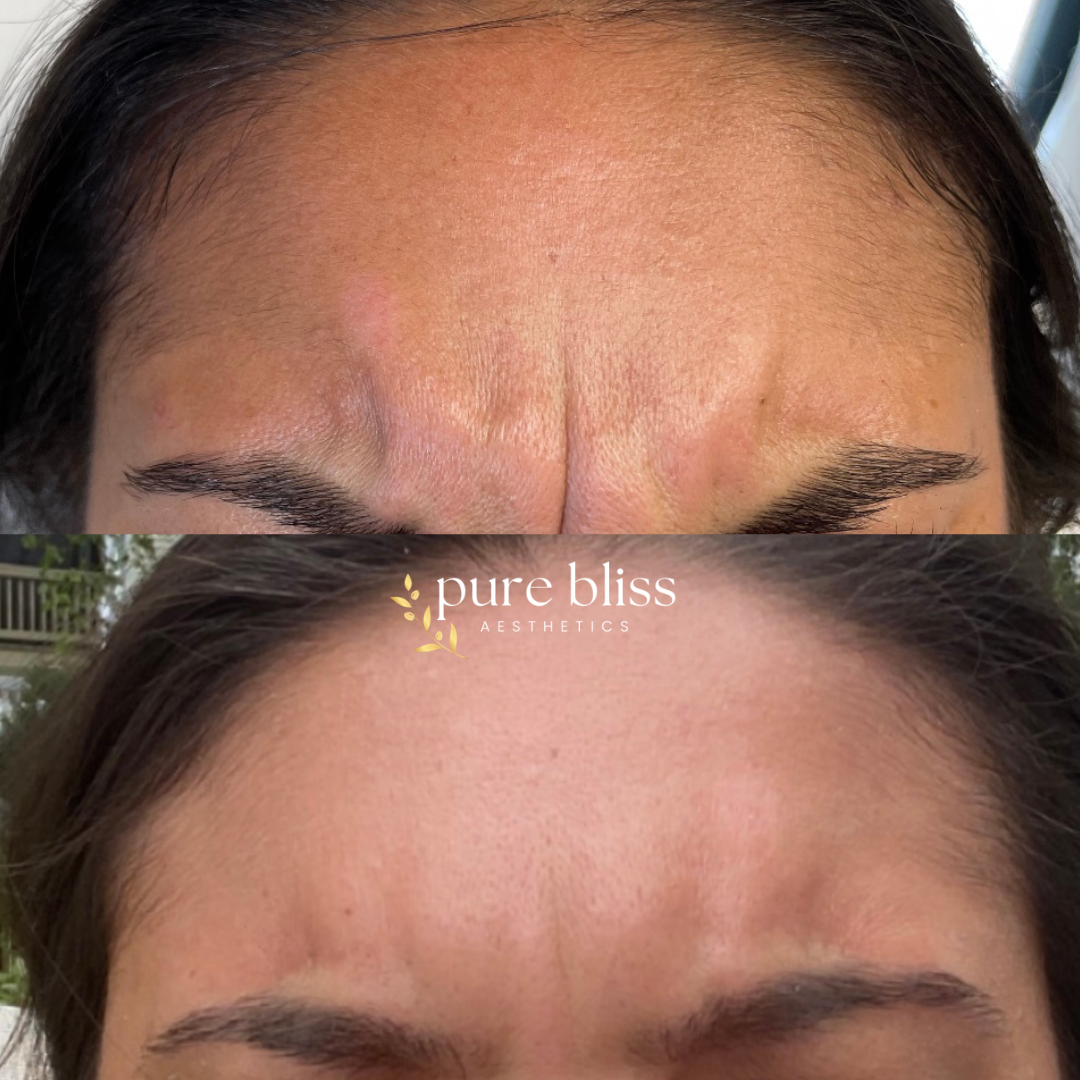 Close-up of forehead wrinkles before and after Botox treatment. Top shows deep frown lines, bottom shows smoothed skin after Dysport injections.