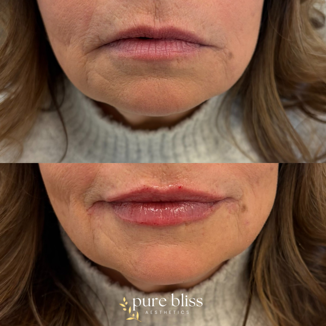 Half syringe of lip filler using 1.2ml Revanesse Versa.