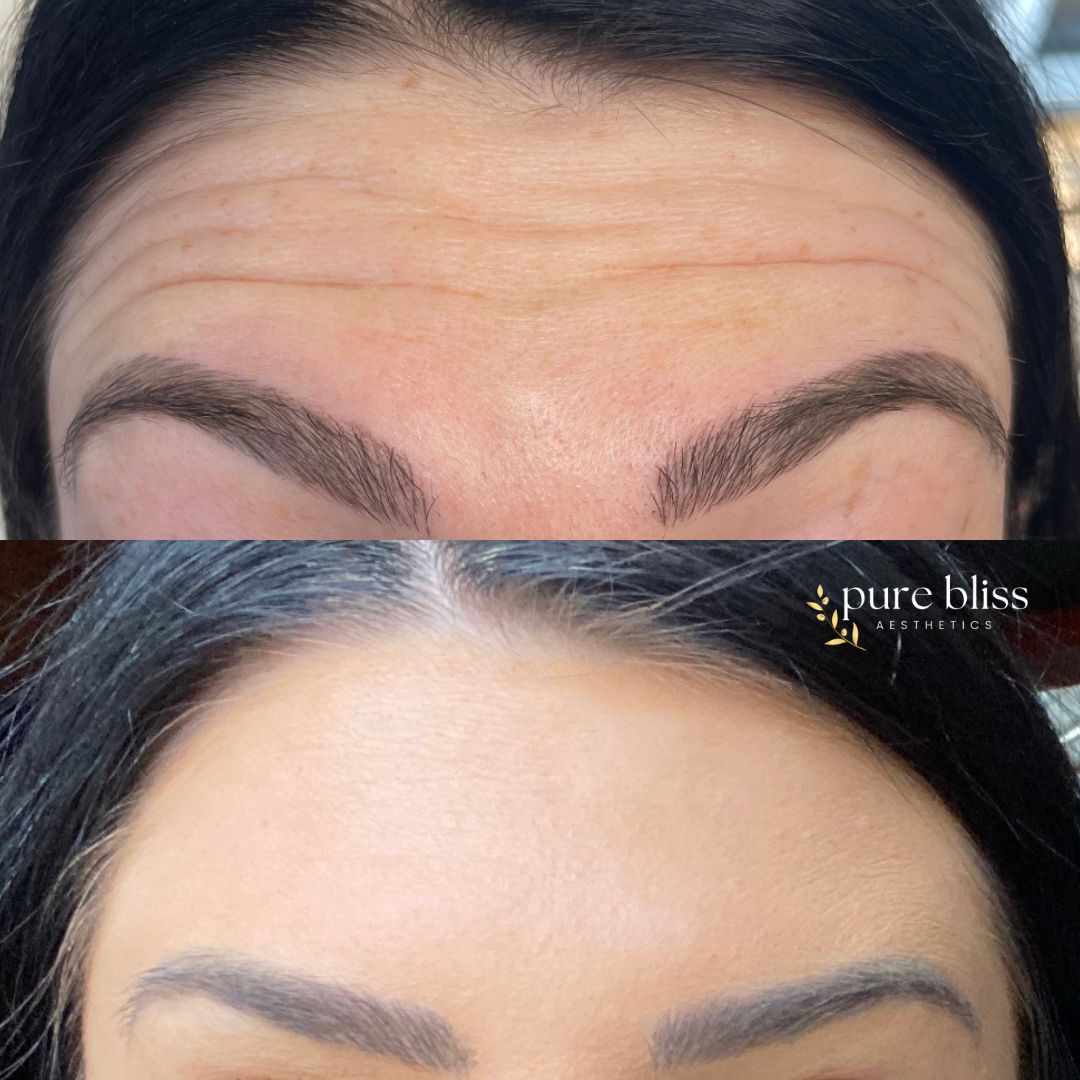 Before and after images of a woman's forehead showing the results of Botox treatment. The top image shows the forehead with prominent wrinkles, while the bottom image shows a smooth, wrinkle-free forehead.