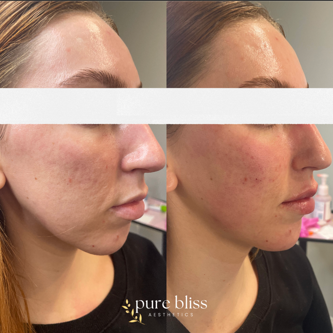 Filler before and after with 0.5ml of Restylane Kysse in the lips and 1ml of Restylane Defyne split up in the cheeks and chin.