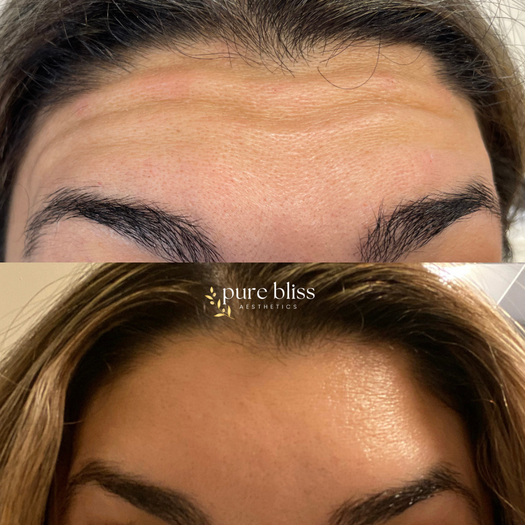 Before and after images of forehead and eyebrow enhancement, showing smoother skin and more defined eyebrows after receiving Dysport.