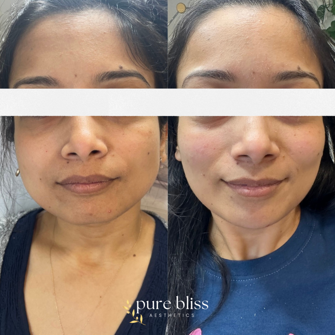 Masseter slimming with dysport.