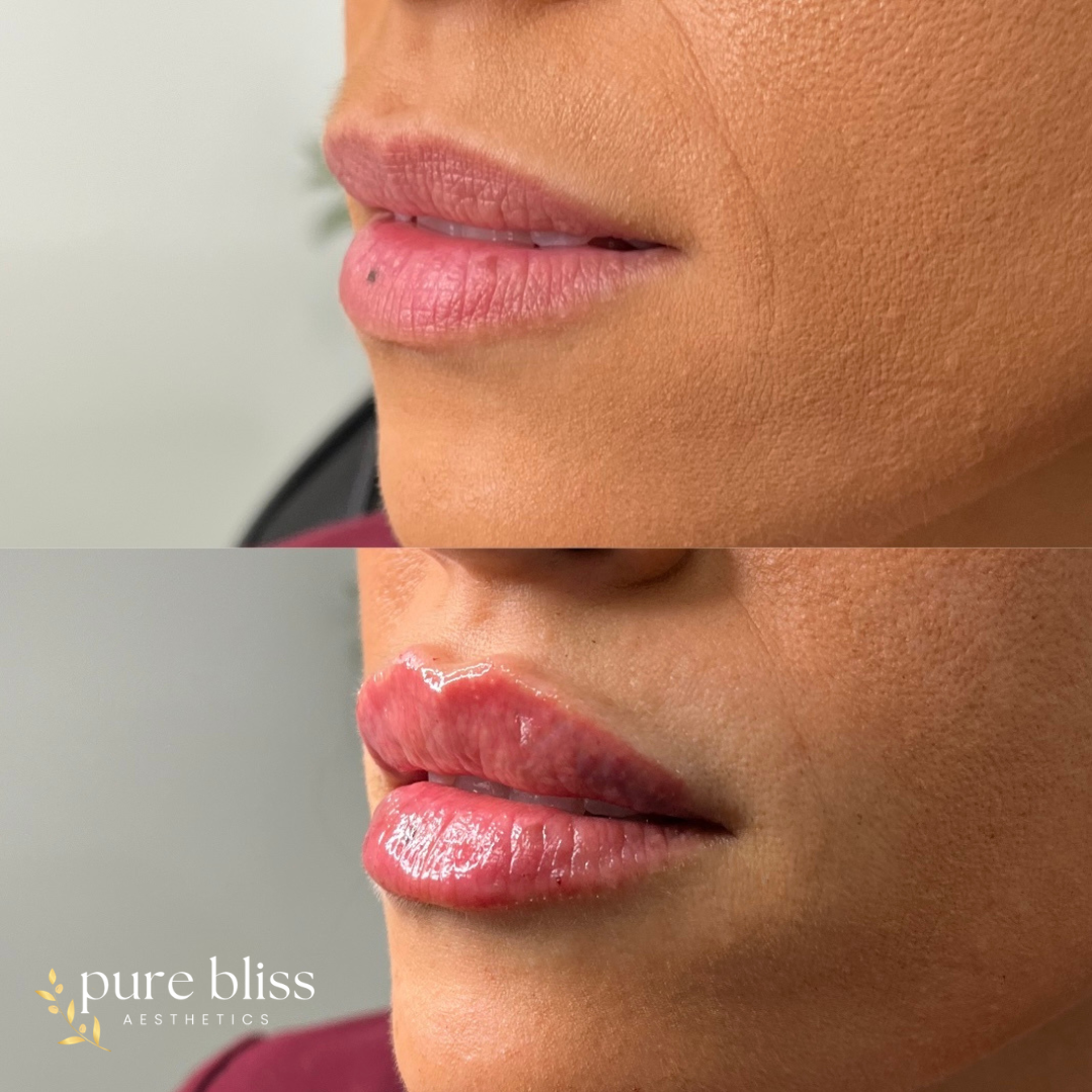 Lip filler before and after with 0.5ml of RHA2.