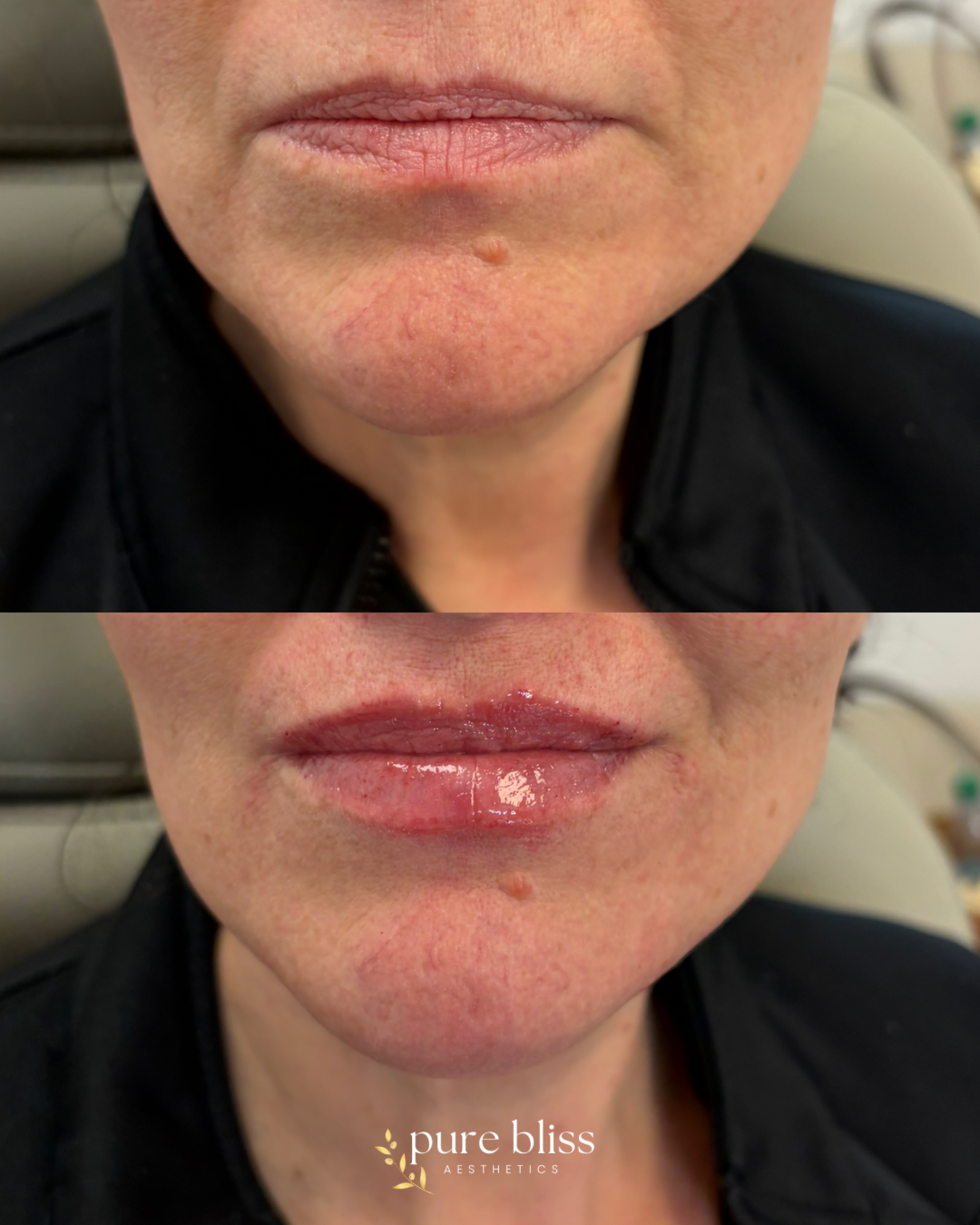 Half syringe of lip filler using 1ml RHA3.