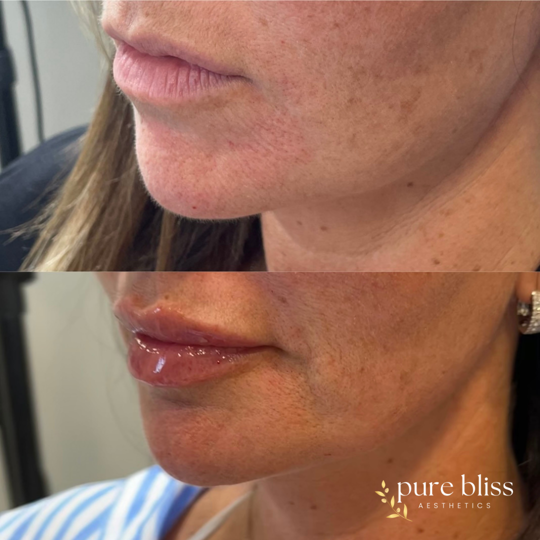 Filler before and after with 0.8ml of Revanesse Versa in the pre-jowl area and marionette lines to help with jowls. 0.4ml remainder placed in lips.