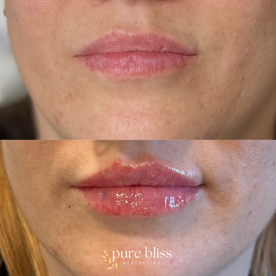 Lip filler before and after with 0.5ml of Restylane Kysse 