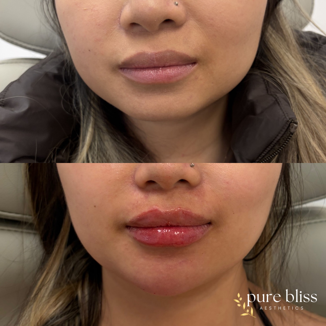 Filler before and after using 2ml of filler in the lips and chin.