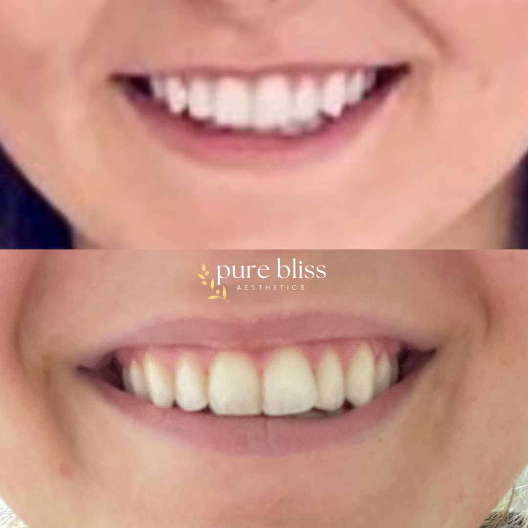 Comparison of a person's smile before and after a lip flip, showing a fuller top lip.