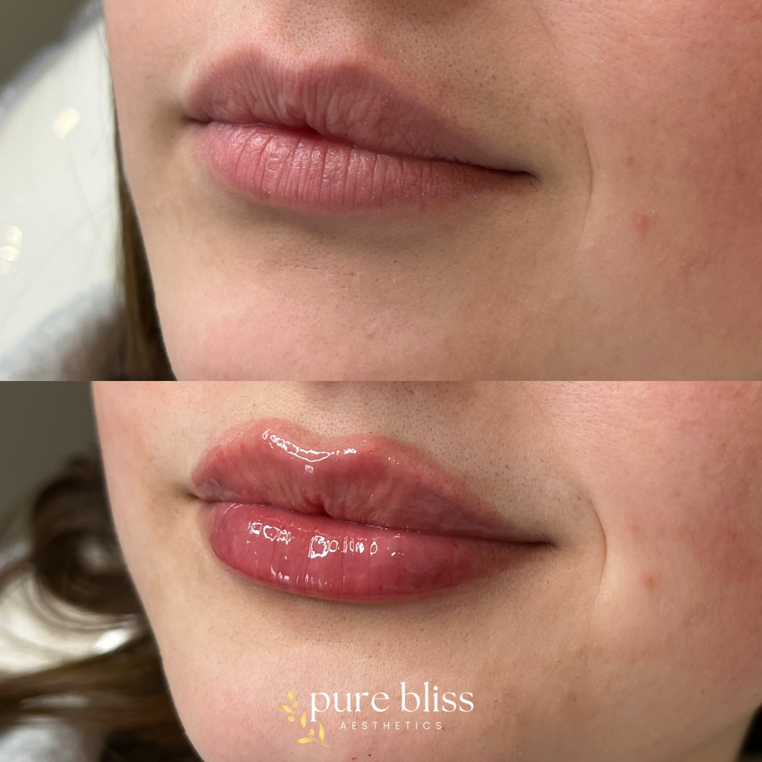 Lip filler before and after with 0.5ml of Restylane Kysse 