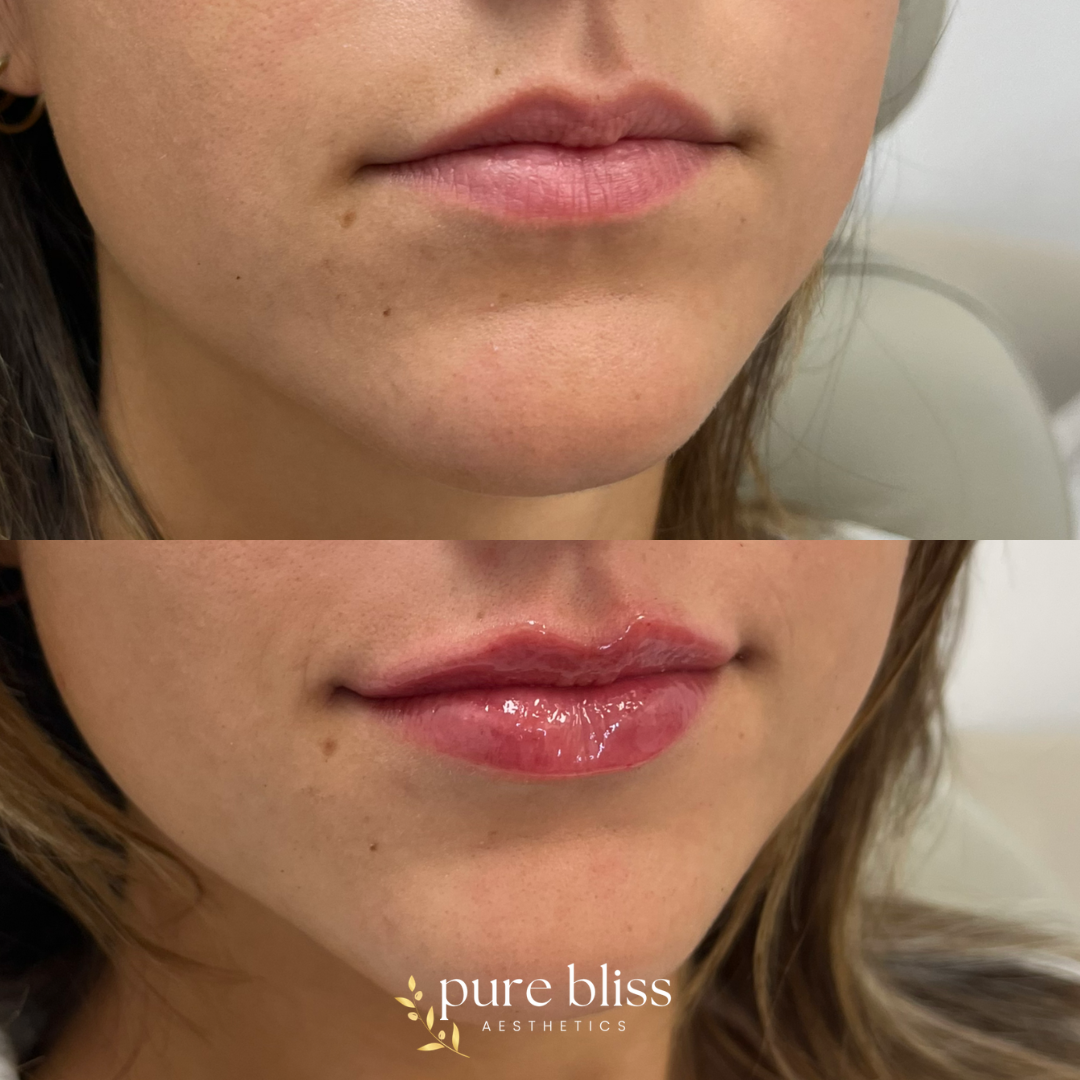 Lip filler before and after with 0.6ml of Versa.