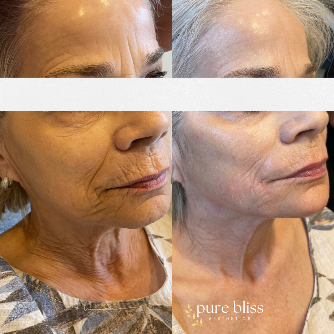 Filler before and after using Radiesse & hyperdilute Radiesse in the cheeks, chin, jawline, and peri-oral.