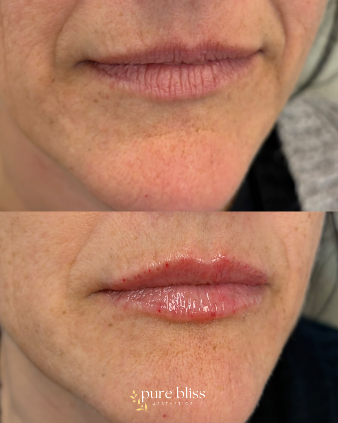 Half syringe of lip filler using 0.6ml Revanesse Versa.