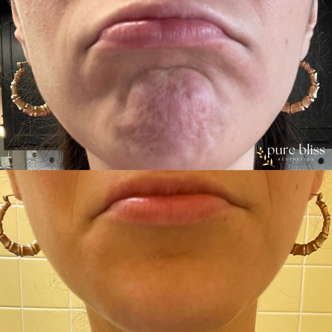 Comparison of a person frowning showing a pebbly chin on the top, and a relaxed and smooth chin on the bottom after Botox.