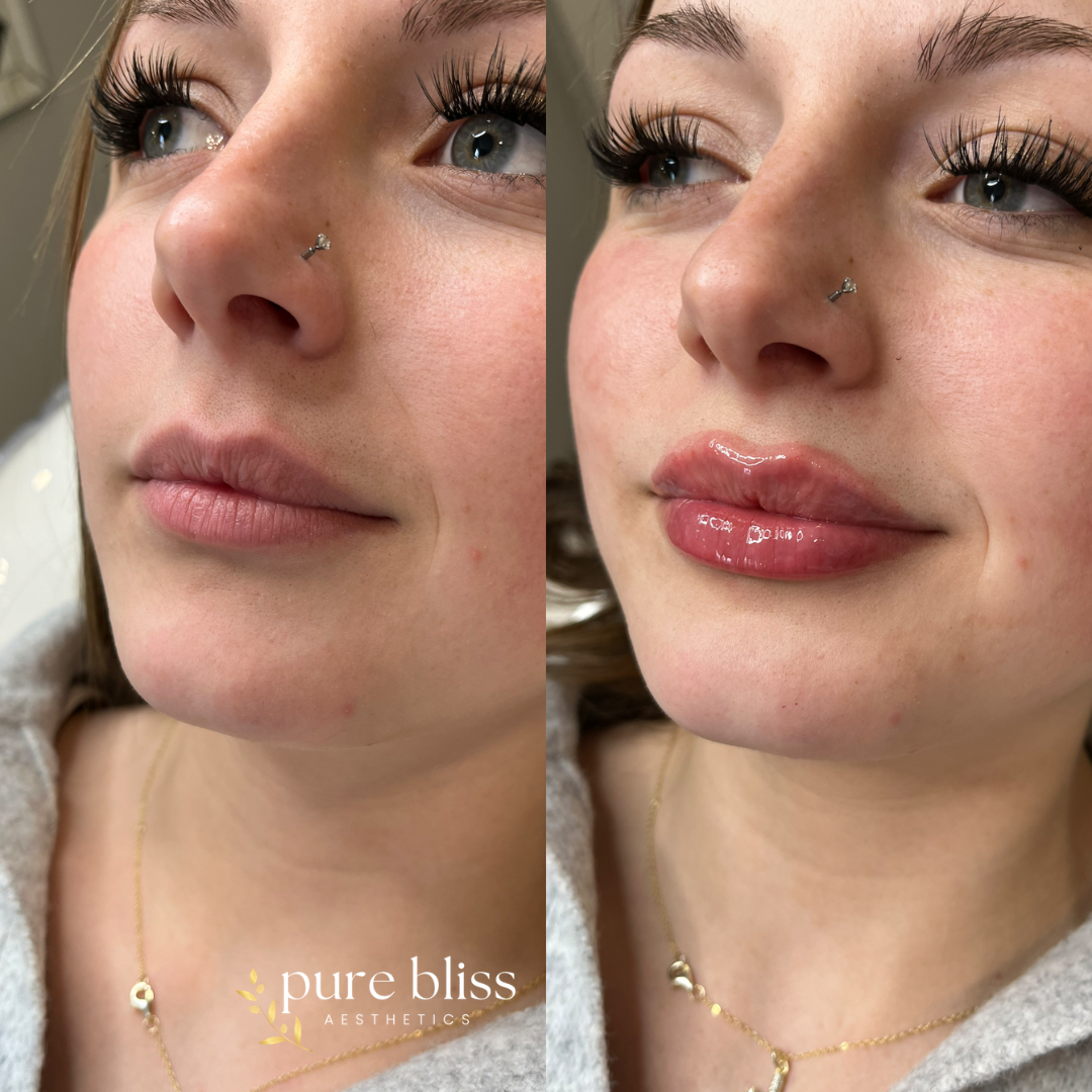 Lip filler before and after with 0.5ml of Restylane Kysse 