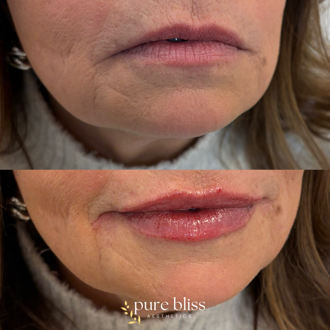 Half syringe of lip filler using 1.2ml Revanesse Versa.