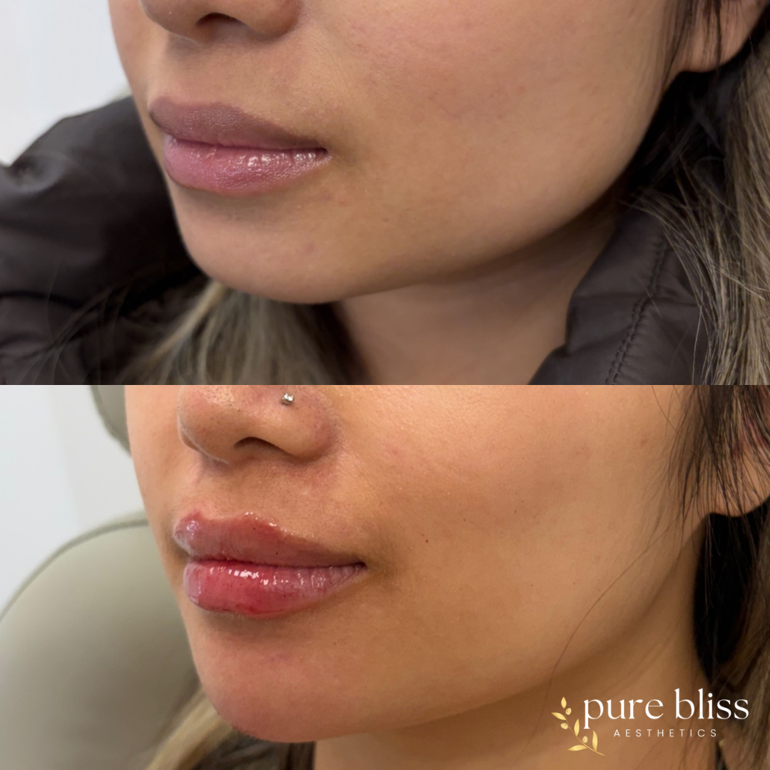 Filler before and after using 2ml of filler in the lips and chin.