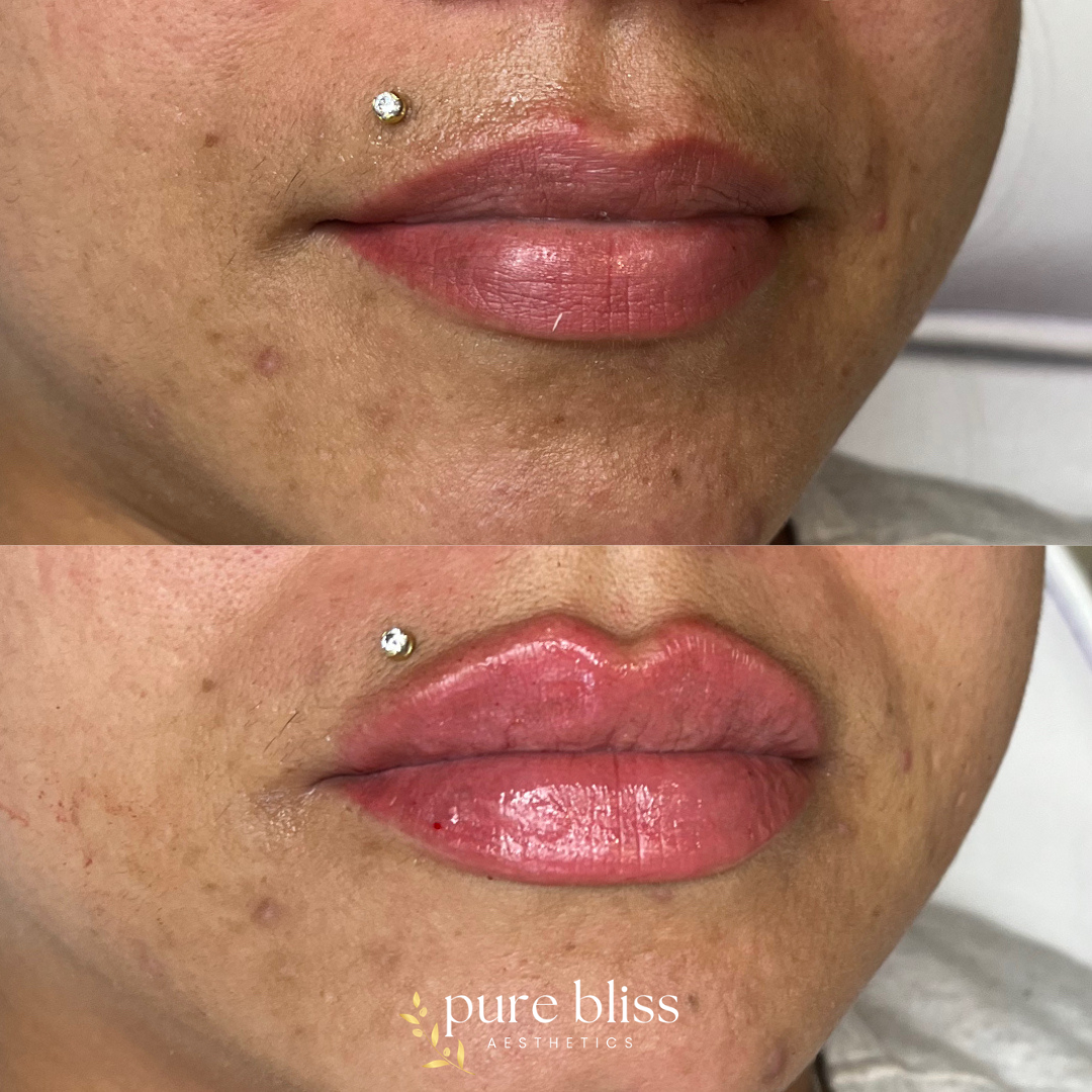 Lip filler before and after with 1.2ml of Revanesse Versa 