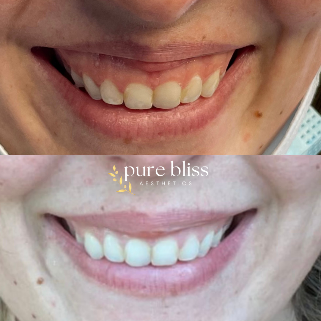 Comparison of a person's smile before and after a lip flip, showing a fuller top lip.